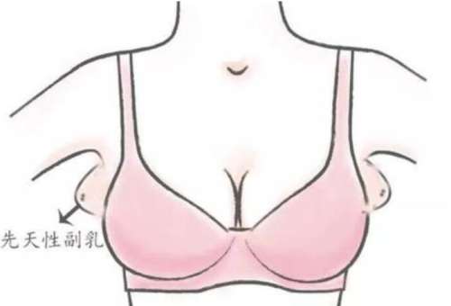 去副乳
