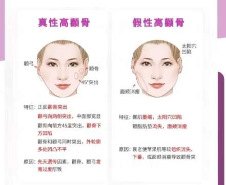 颧骨内推