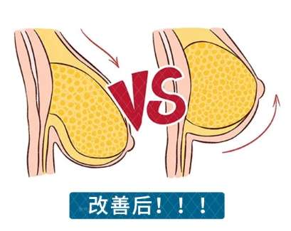 胸部悬吊术
