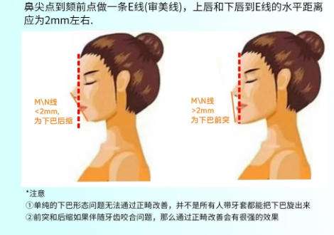 假体下巴2.jpg