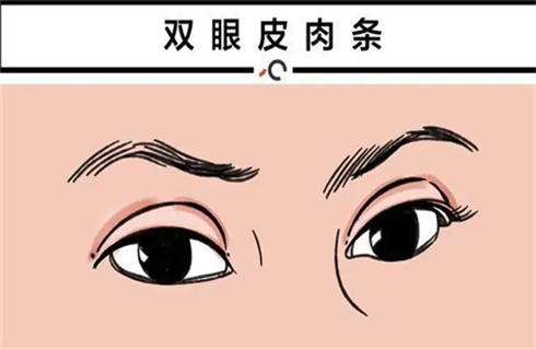上海娜慕医疗美容医院双眼皮怎么样?医生点评,案例图