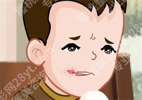 上火嘴唇起泡怎么办怎么快速消除?什么原因导致,整理多方面知识点