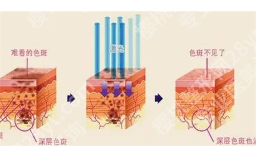 淮北人民医院祛斑怎么样?特色项目介绍,医生介绍