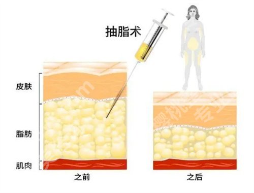 运城市中心医院整形科吸脂怎么样?看医院口碑、亮点介绍