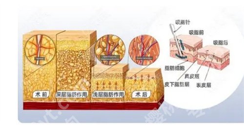 运城市中心医院整形科吸脂怎么样?看医院口碑、亮点介绍