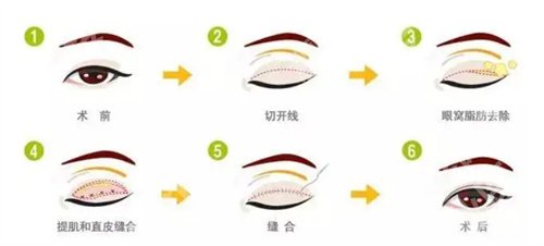 中山大学附属第一医院割双眼皮怎么样？真实案例反馈
