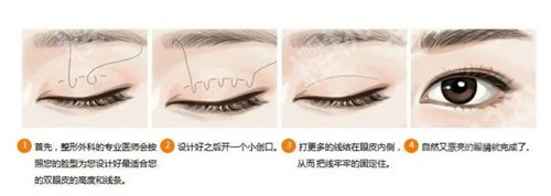 中山大学附属第一医院割双眼皮怎么样？真实案例反馈