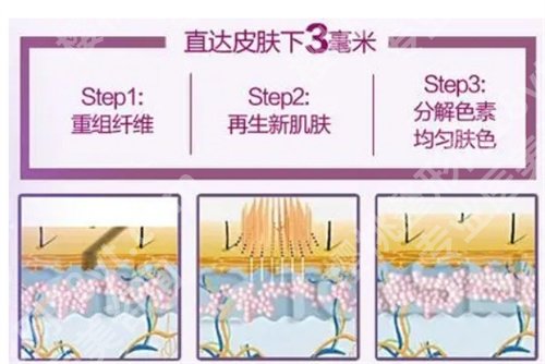 中山大学附属第一医院割双眼皮怎么样？真实案例反馈