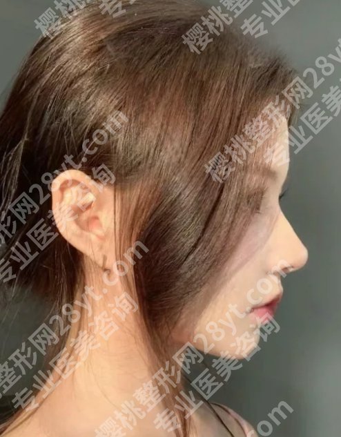 邓柏林做鼻子怎么样?内附手术全过程以及挑选医生小经验
