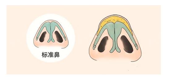 缩鼻头会影响呼吸吗?效果好吗?避免后遗症的注意事项收藏起来!