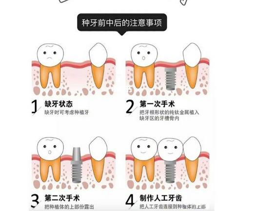 深圳同步齿科做种植牙怎么样?多少钱?医院实力、技术优势、价格表更新