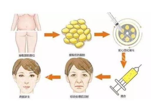 李朕做脂肪填充怎么样?北京圣嘉新医生介绍!技术审美双优!