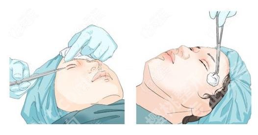 马梅生面部吸脂多少钱啊?价格明细、医生技术特色等介绍!面诊指南
