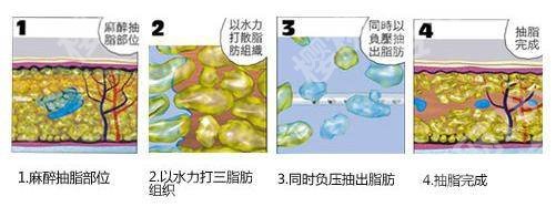 北京航天七三一医院吸脂多少钱？2024价格\陈志刚简介\吸脂瘦腰腹案例
