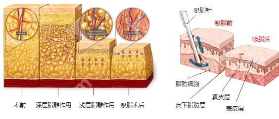 北京航天七三一医院吸脂多少钱？2024价格\陈志刚简介\吸脂瘦腰腹案例