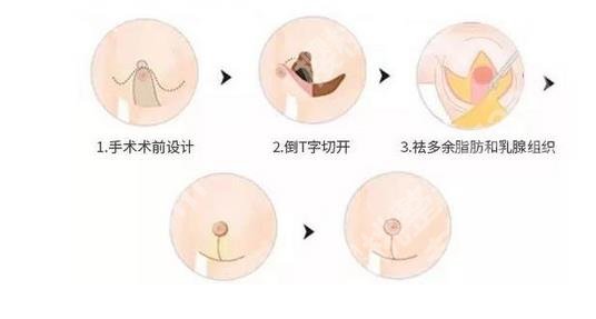 上海第一人民医院缩胸手术费用、专家信息揭晓!价格27699元起!