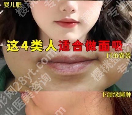 杭州面部吸脂哪家医院好？各医院代表医生及地理位置分享！