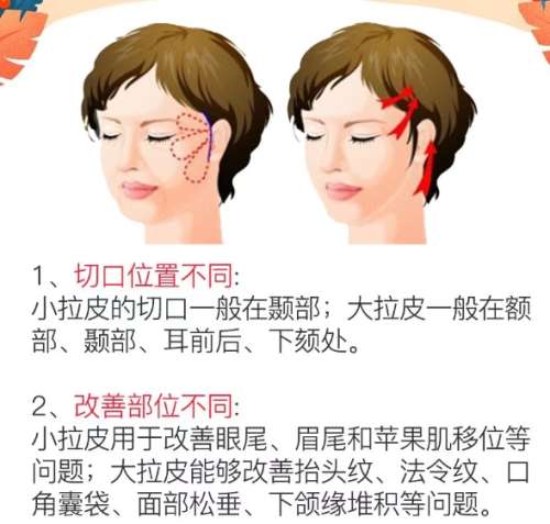 拉皮
