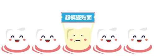 瓷贴面