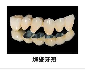 烤瓷牙