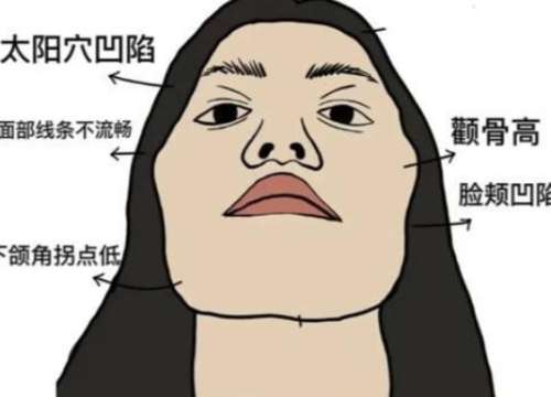 颧骨内推.jpg