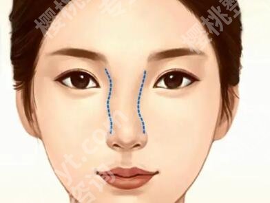江苏盐城艾美莉整形医院做鼻子怎么样好吗?了解医院参考价格详情