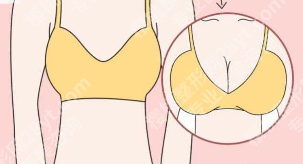 成都华西医院丰胸怎么样？分享医院信息和丰胸案例揭晓