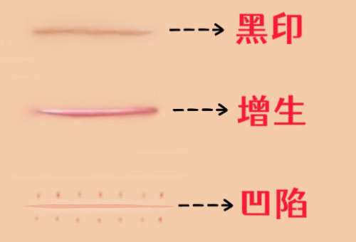 祛疤4.jpg 祛疤4.jpg