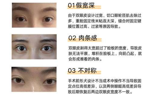 双眼皮修复2.jpg