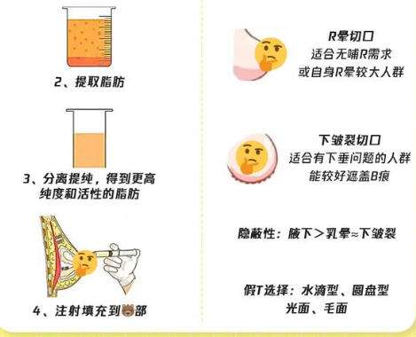 脂肪隆胸.jpg 脂肪隆胸.jpg