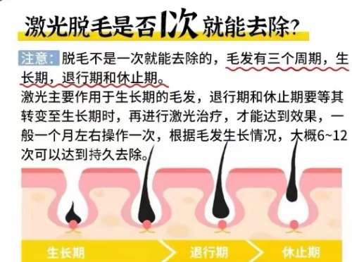 激光脱毛