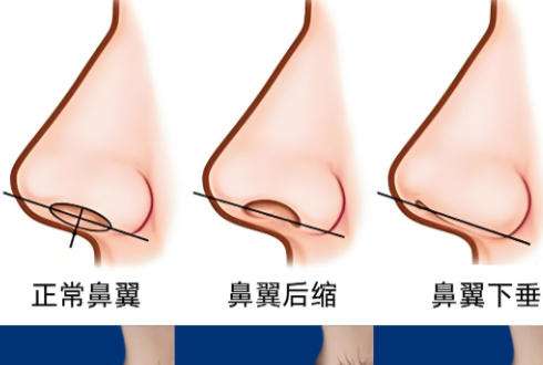 鼻修复8.jpg 鼻修复8.jpg
