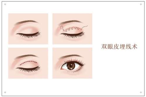 埋线双眼皮2.jpg