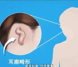 耳再造01.jpg
