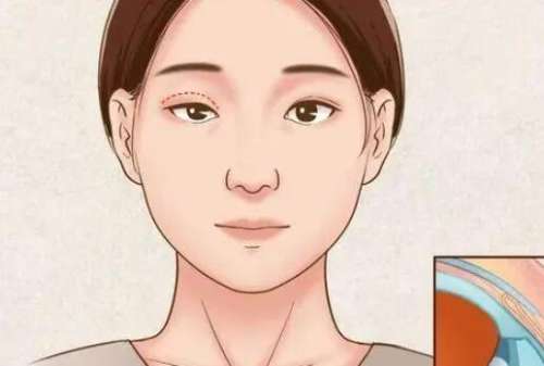 医院双眼皮手术可以报销吗.jpg
