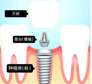 牙齿种植