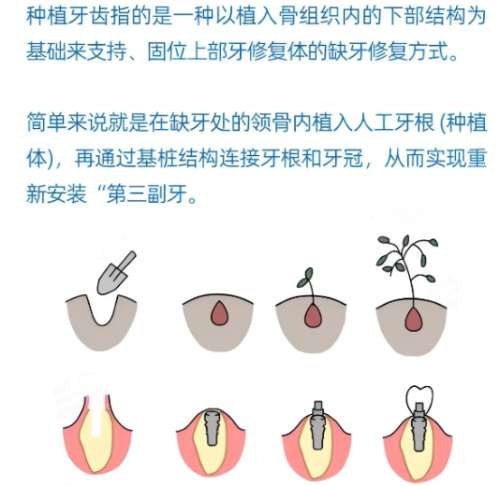 牙齿种植