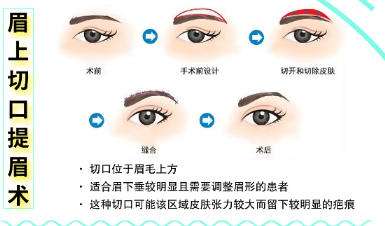 提眉