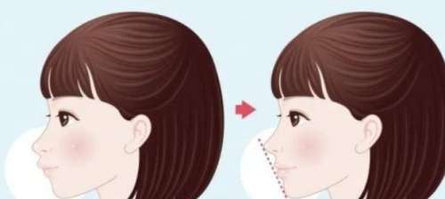 正颌