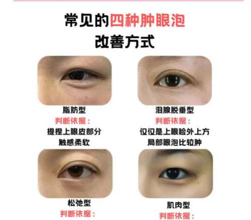 双眼皮修复 双眼皮修复