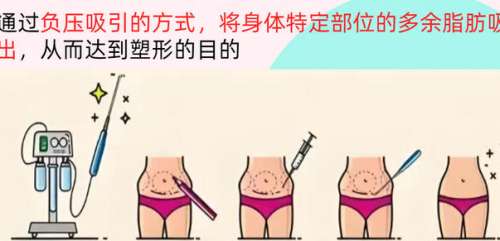 吸脂