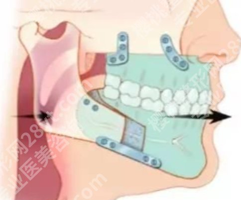 八大处磨骨专家，医生名单、技术风格与典型案例风格一篇看懂