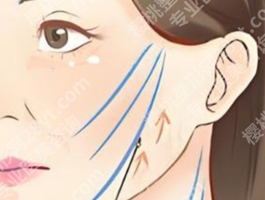 哈尔滨做拉皮手术好的医院医生有哪些？医院和医生信息这次一起汇总