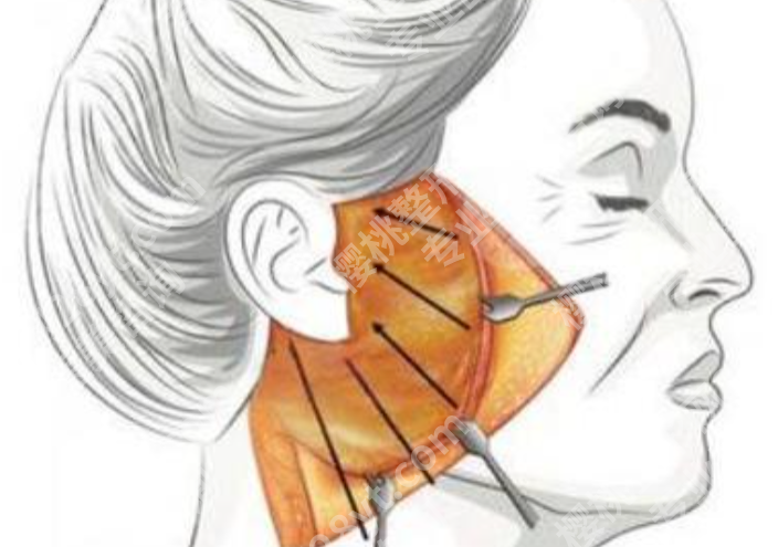 齐齐哈尔拉皮哪家做得好？从审美到恢复反馈，几个重点都替你整理了