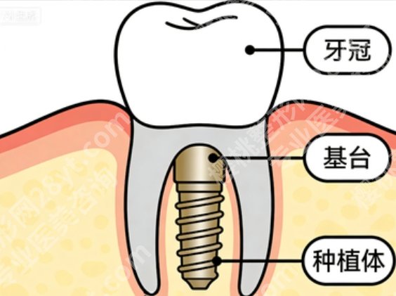 秦皇岛全口种植牙哪家好?能做全口的靠谱机构终于整理出来了