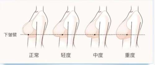 隆胸