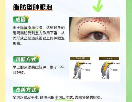 双眼皮
