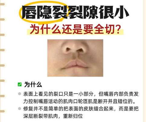 唇裂修复.jpg