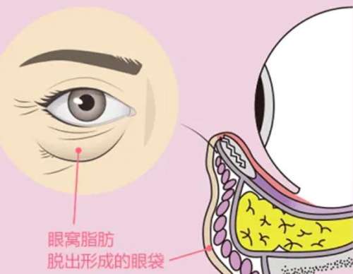 眼袋 眼袋