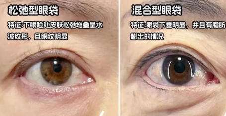 去眼袋